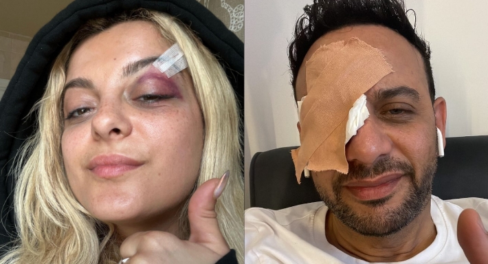 ظاهرة عجيبة .. 3 مطربين يصابوا في العين في نفس الأسبوع!