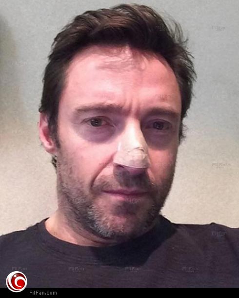 شفاء هيو جاكمان من سرطان الجلد