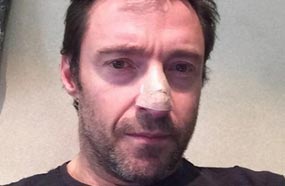 شفاء هيو جاكمان من سرطان الجلد