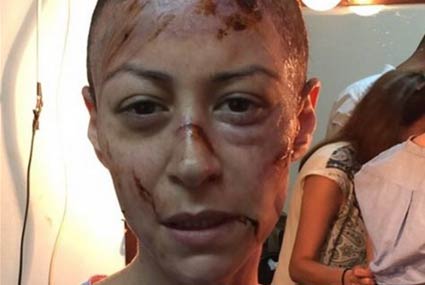 منة شلبي بكدمات طفيفة في وجهها 